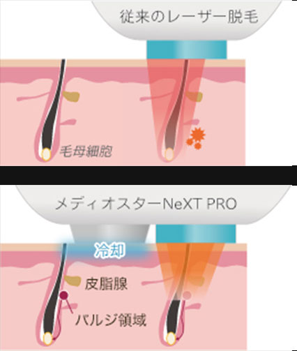 従来レーザーとメディオスターNeXT PROの施術イメージ図